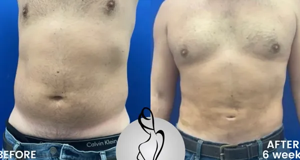 liposuction-360