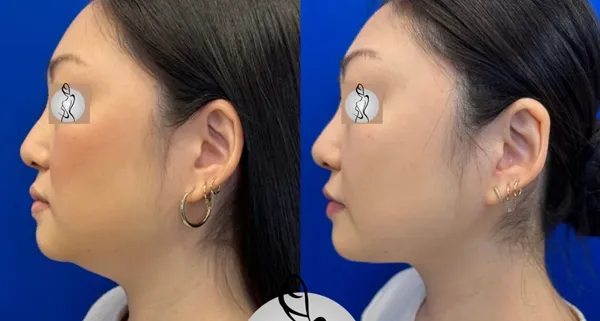 neck-lift