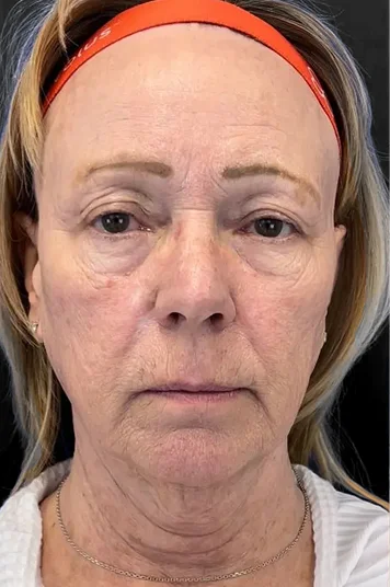 Before and after image