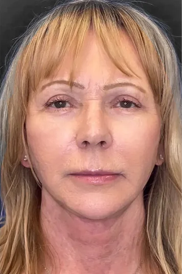 Before and after image