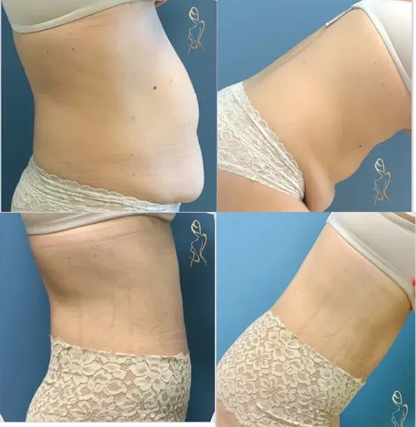 Real patient results before and after plastic surgery results in Long Island, NY, performed by Dr. Sotirios Papafragkou.