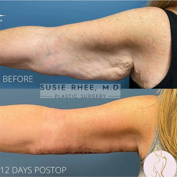 Real patient results before and after plastic surgery results in Long Island, NY, performed by Dr. Sotirios Papafragkou.