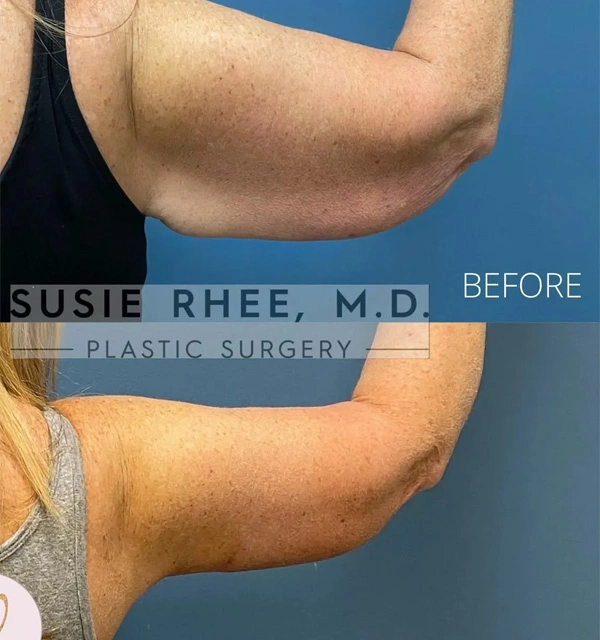Real patient results before and after plastic surgery results in Long Island, NY, performed by Dr. Sotirios Papafragkou.