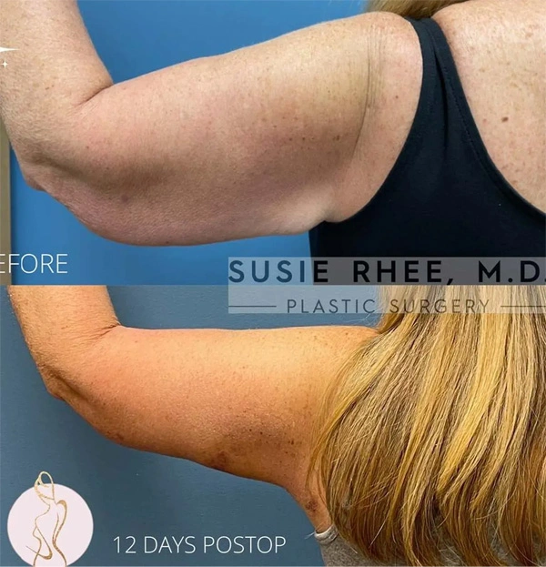 Real patient results before and after plastic surgery results in Long Island, NY, performed by Dr. Sotirios Papafragkou.