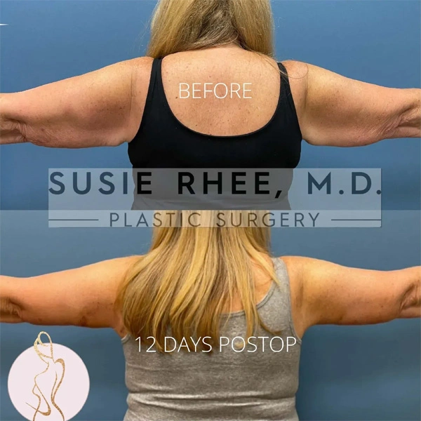 Real patient results before and after plastic surgery results in Long Island, NY, performed by Dr. Sotirios Papafragkou.