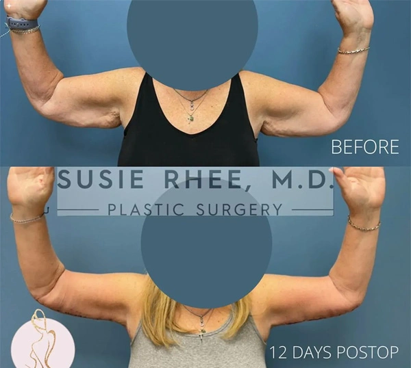 Real patient results before and after plastic surgery results in Long Island, NY, performed by Dr. Sotirios Papafragkou.