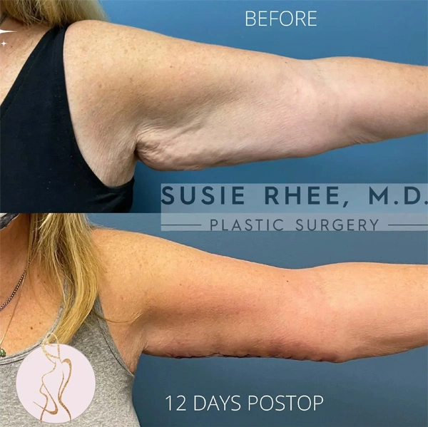 Real patient results before and after plastic surgery results in Long Island, NY, performed by Dr. Sotirios Papafragkou.