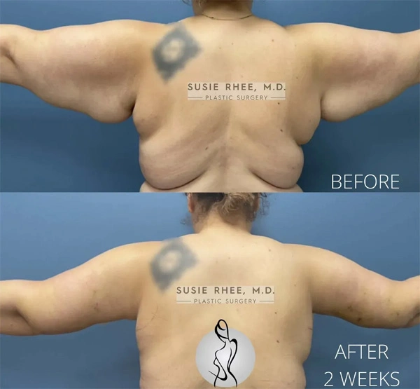 Real patient results before and after plastic surgery results in Long Island, NY, performed by Dr. Sotirios Papafragkou.