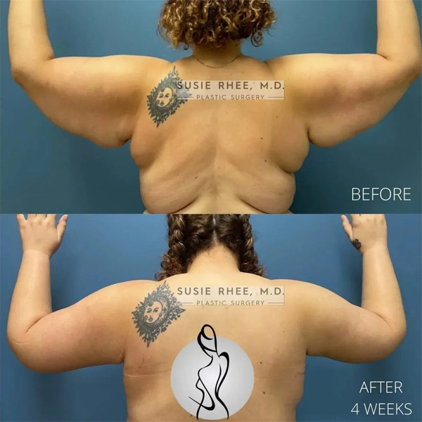 Real patient results before and after plastic surgery results in Long Island, NY, performed by Dr. Sotirios Papafragkou.