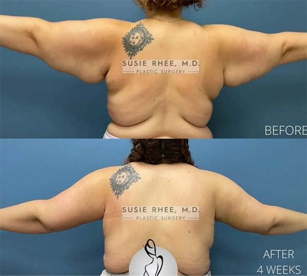 Real patient results before and after plastic surgery results in Long Island, NY, performed by Dr. Sotirios Papafragkou.