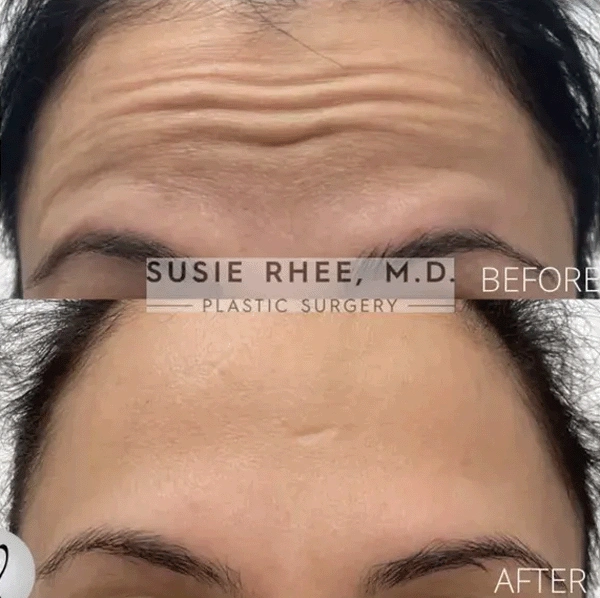 Real patient results before and after plastic surgery results in Long Island, NY, performed by Dr. Sotirios Papafragkou.
