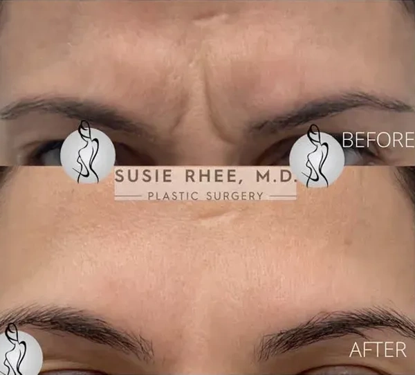 Real patient results before and after plastic surgery results in Long Island, NY, performed by Dr. Sotirios Papafragkou.