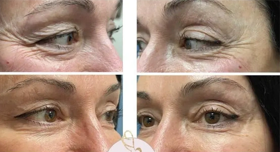 Real patient results before and after plastic surgery results in Long Island, NY, performed by Dr. Sotirios Papafragkou.