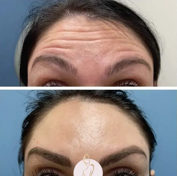 Real patient results before and after plastic surgery results in Long Island, NY, performed by Dr. Sotirios Papafragkou.