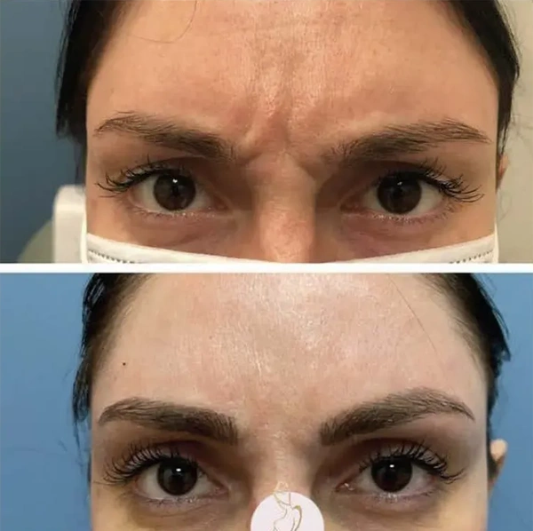 Real patient results before and after plastic surgery results in Long Island, NY, performed by Dr. Sotirios Papafragkou.