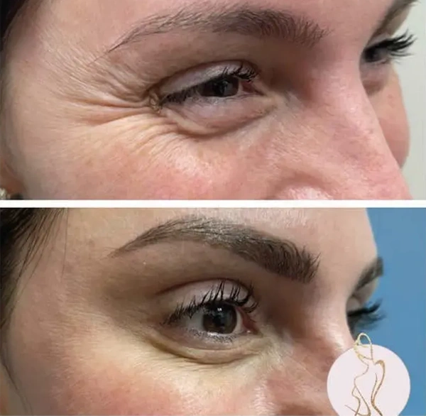Real patient results before and after plastic surgery results in Long Island, NY, performed by Dr. Sotirios Papafragkou.