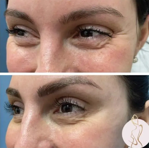 Real patient results before and after plastic surgery results in Long Island, NY, performed by Dr. Sotirios Papafragkou.