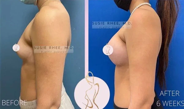 Real patient results before and after plastic surgery results in Long Island, NY, performed by Dr. Sotirios Papafragkou.