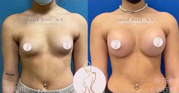 Real patient results before and after plastic surgery results in Long Island, NY, performed by Dr. Sotirios Papafragkou.