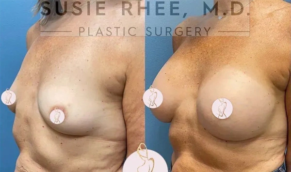 Real patient results before and after plastic surgery results in Long Island, NY, performed by Dr. Sotirios Papafragkou.