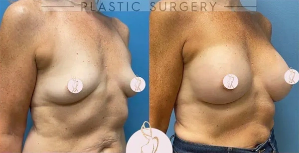 Real patient results before and after plastic surgery results in Long Island, NY, performed by Dr. Sotirios Papafragkou.