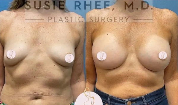 Real patient results before and after plastic surgery results in Long Island, NY, performed by Dr. Sotirios Papafragkou.