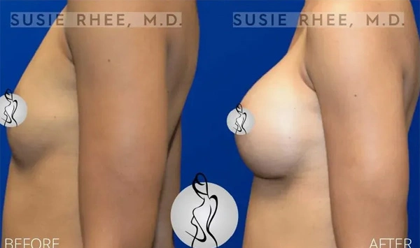 Real patient results before and after plastic surgery results in Long Island, NY, performed by Dr. Sotirios Papafragkou.