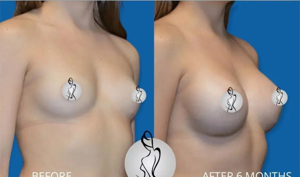 Real patient results before and after plastic surgery results in Long Island, NY, performed by Dr. Sotirios Papafragkou.