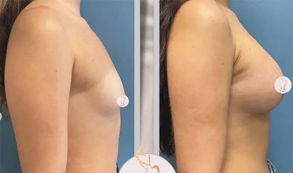 Real patient results before and after plastic surgery results in Long Island, NY, performed by Dr. Sotirios Papafragkou.