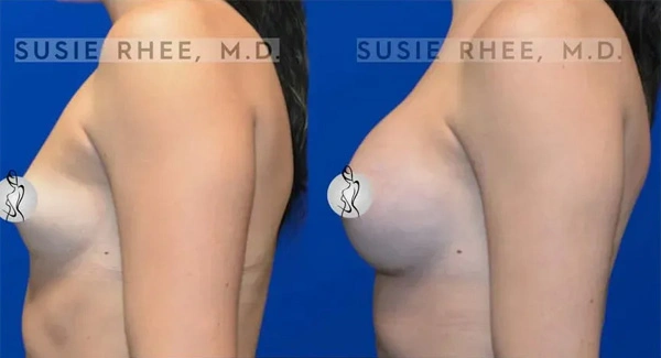 Real patient results before and after plastic surgery results in Long Island, NY, performed by Dr. Sotirios Papafragkou.