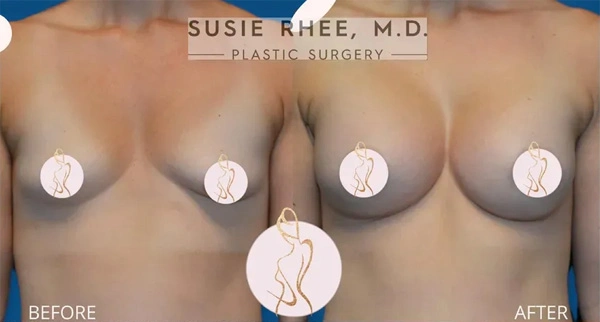 Real patient results before and after plastic surgery results in Long Island, NY, performed by Dr. Sotirios Papafragkou.