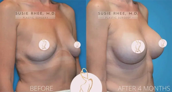 Real patient results before and after plastic surgery results in Long Island, NY, performed by Dr. Sotirios Papafragkou.