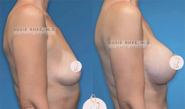 Real patient results before and after plastic surgery results in Long Island, NY, performed by Dr. Sotirios Papafragkou.