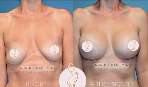 Real patient results before and after plastic surgery results in Long Island, NY, performed by Dr. Sotirios Papafragkou.