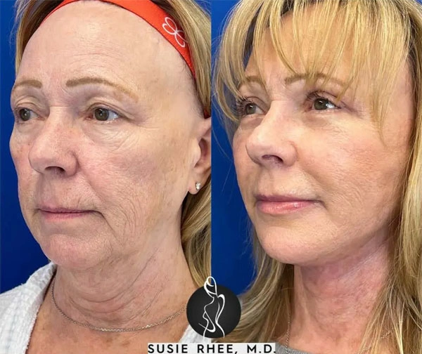 Real patient results before and after plastic surgery results in Long Island, NY, performed by Dr. Sotirios Papafragkou.