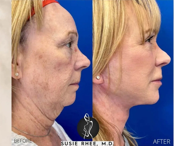Real patient results before and after plastic surgery results in Long Island, NY, performed by Dr. Sotirios Papafragkou.