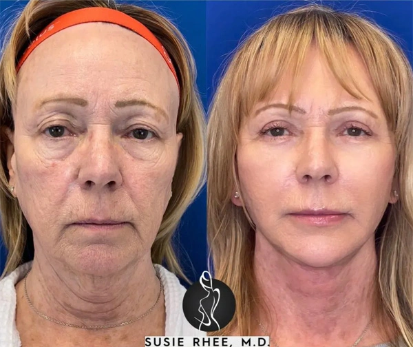 Real patient results before and after plastic surgery results in Long Island, NY, performed by Dr. Sotirios Papafragkou.