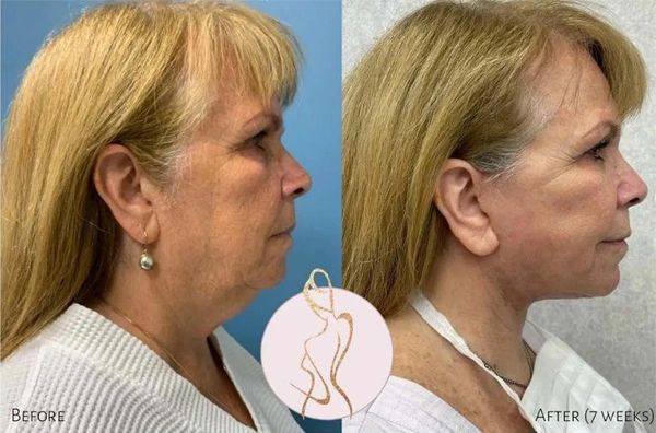 Real patient results before and after plastic surgery results in Long Island, NY, performed by Dr. Sotirios Papafragkou.