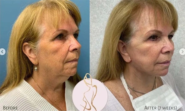 Real patient results before and after plastic surgery results in Long Island, NY, performed by Dr. Sotirios Papafragkou.