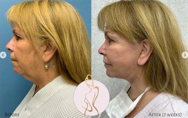 Real patient results before and after plastic surgery results in Long Island, NY, performed by Dr. Sotirios Papafragkou.