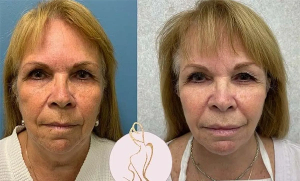Real patient results before and after plastic surgery results in Long Island, NY, performed by Dr. Sotirios Papafragkou.