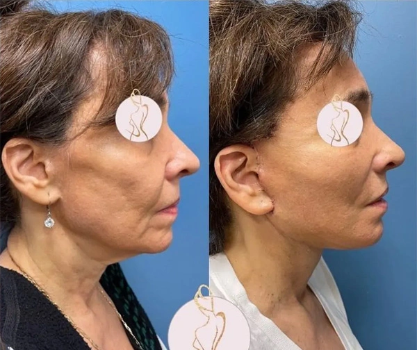 Real patient results before and after plastic surgery results in Long Island, NY, performed by Dr. Sotirios Papafragkou.