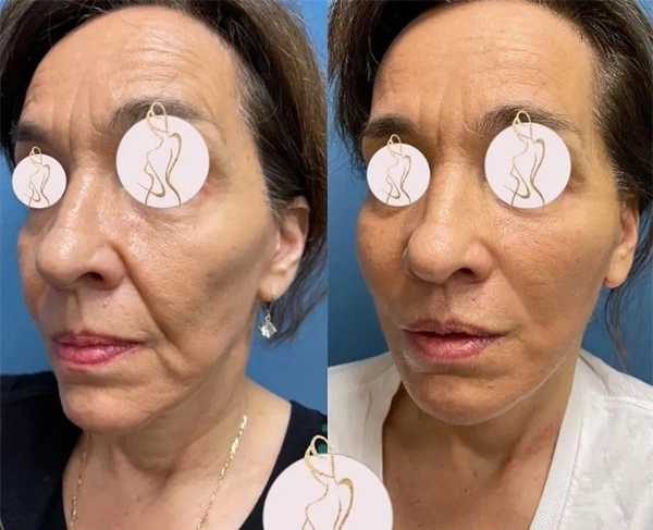 Real patient results before and after plastic surgery results in Long Island, NY, performed by Dr. Sotirios Papafragkou.