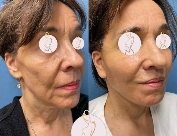 Real patient results before and after plastic surgery results in Long Island, NY, performed by Dr. Sotirios Papafragkou.