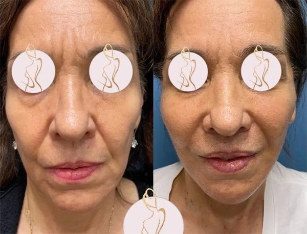 Real patient results before and after plastic surgery results in Long Island, NY, performed by Dr. Sotirios Papafragkou.