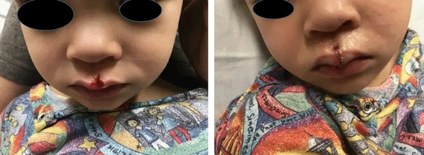 Real patient results before and after plastic surgery results in Long Island, NY, performed by Dr. Sotirios Papafragkou.