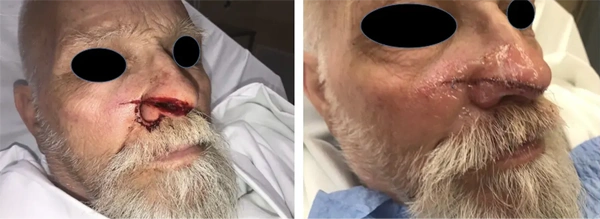 Real patient results before and after plastic surgery results in Long Island, NY, performed by Dr. Sotirios Papafragkou.