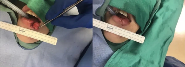 Real patient results before and after plastic surgery results in Long Island, NY, performed by Dr. Sotirios Papafragkou.
