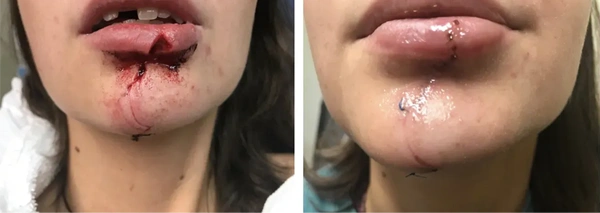 Real patient results before and after plastic surgery results in Long Island, NY, performed by Dr. Sotirios Papafragkou.