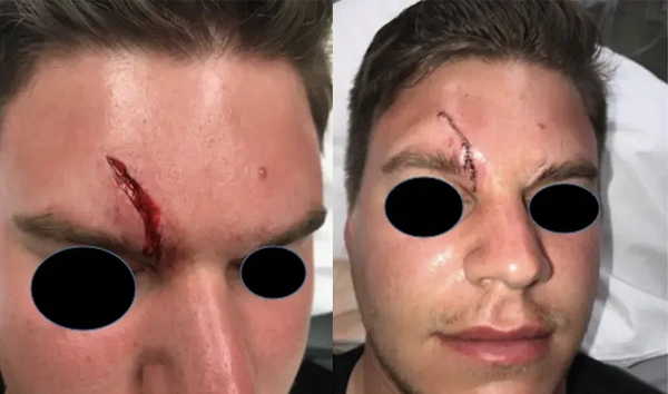 Real patient results before and after plastic surgery results in Long Island, NY, performed by Dr. Sotirios Papafragkou.